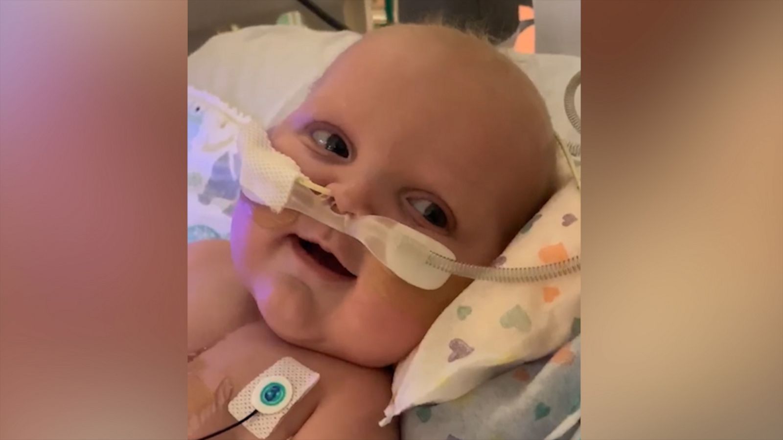 VIDEO: Baby who had two open-heart surgeries smiles for first time