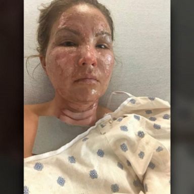 VIDEO: Woman burned after off-brand hand sanitizer catches fire