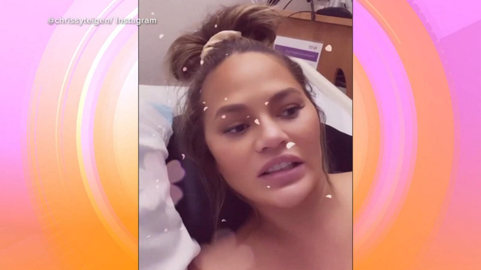 Chrissy Teigen reveals why she's getting botox during pregnancy