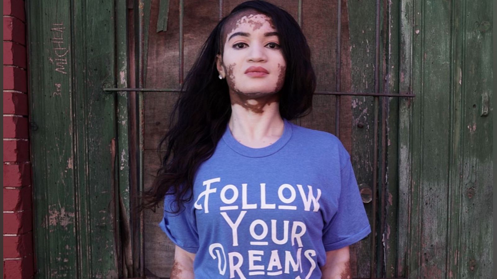 VIDEO: She used to spray tan to cover her vitiligo, now she’ll never hide her true beauty