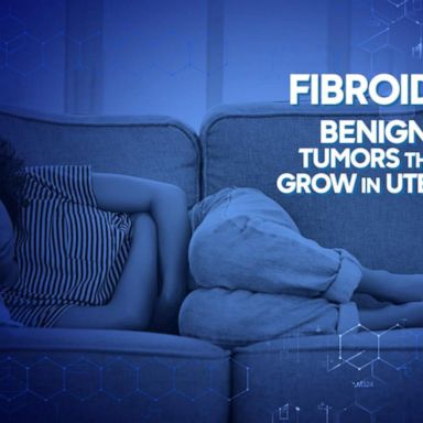 VIDEO: How 1 doctor is helping women suffering from fibroids