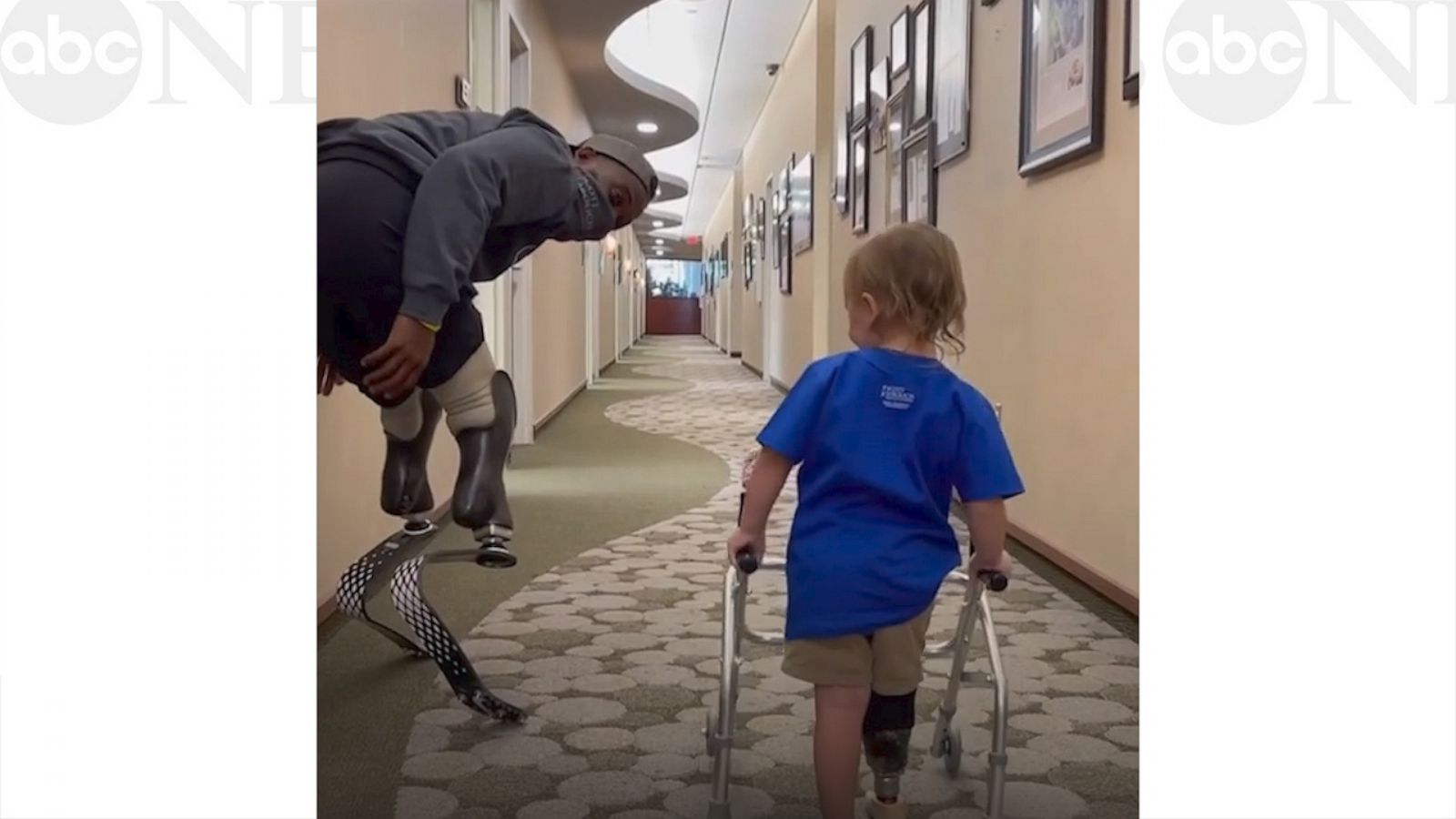 VIDEO: I’m not crying, you are! Watch as this amputee toddler walks for the first time