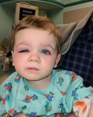 Baby wakes up deals with swollen eyelid