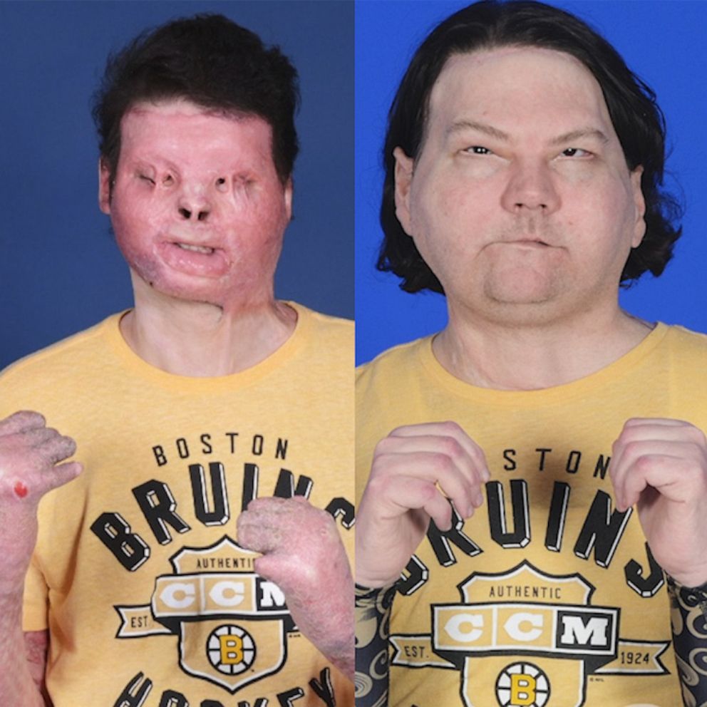 This Man's Face Transplant Story Is Incredibly Inspiring