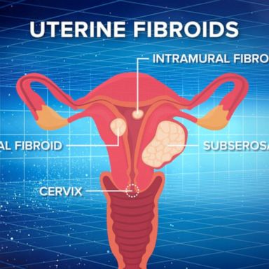 Woman who had uterine fibroids removed urges others to self-advocate at ...