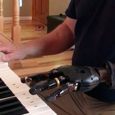 VIDEO: Man who lost arm to cancer learns to play piano with prosthetic limb