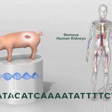 VIDEO: Medical breakthrough: First pig to human kidney transplant 