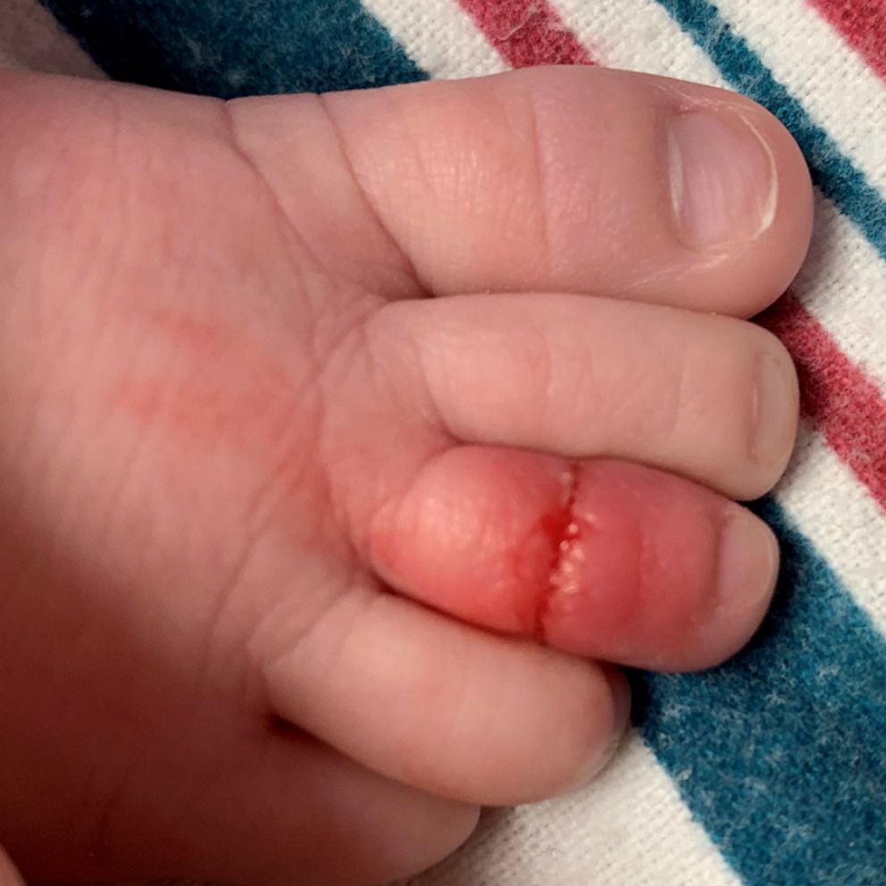 Video Mom shares warning after hazard cut off her baby's