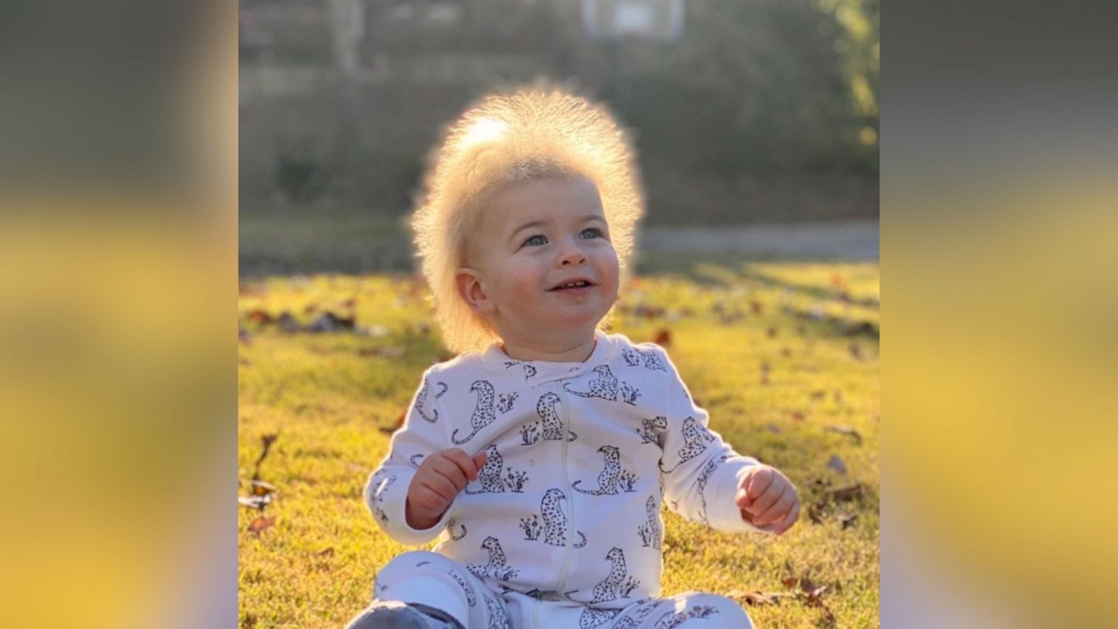 VIDEO: One-year-old boy has extremely rare ‘uncombable hair syndrome’