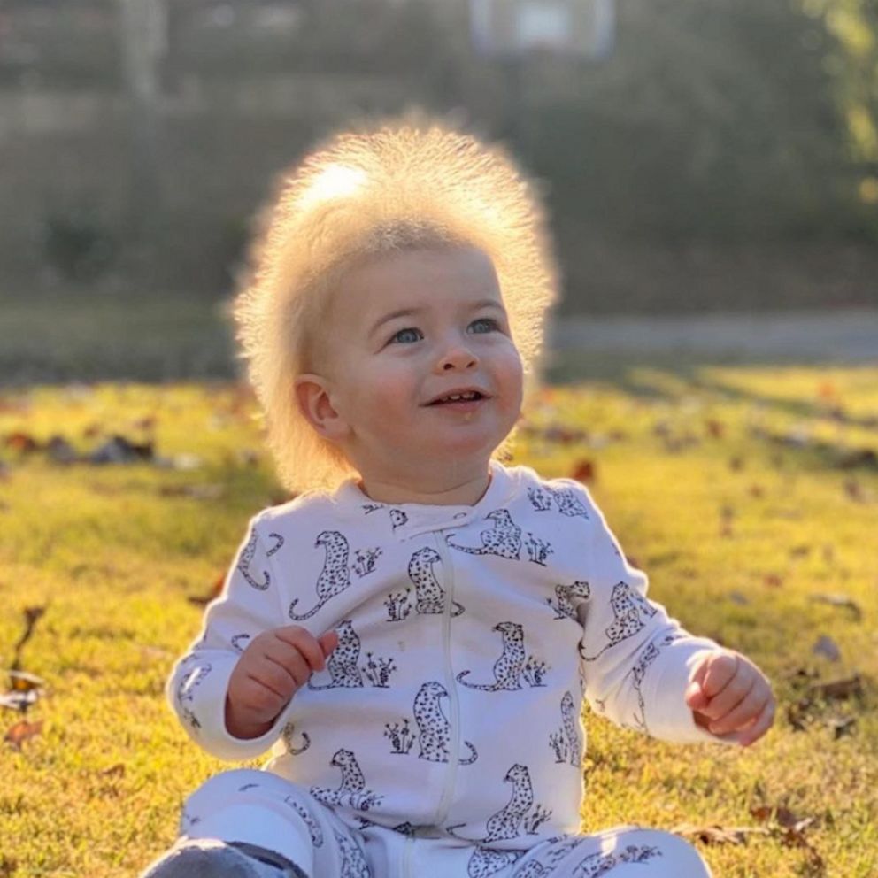 Video One-year-old boy has extremely rare 'uncombable hair syndrome' - ABC  News