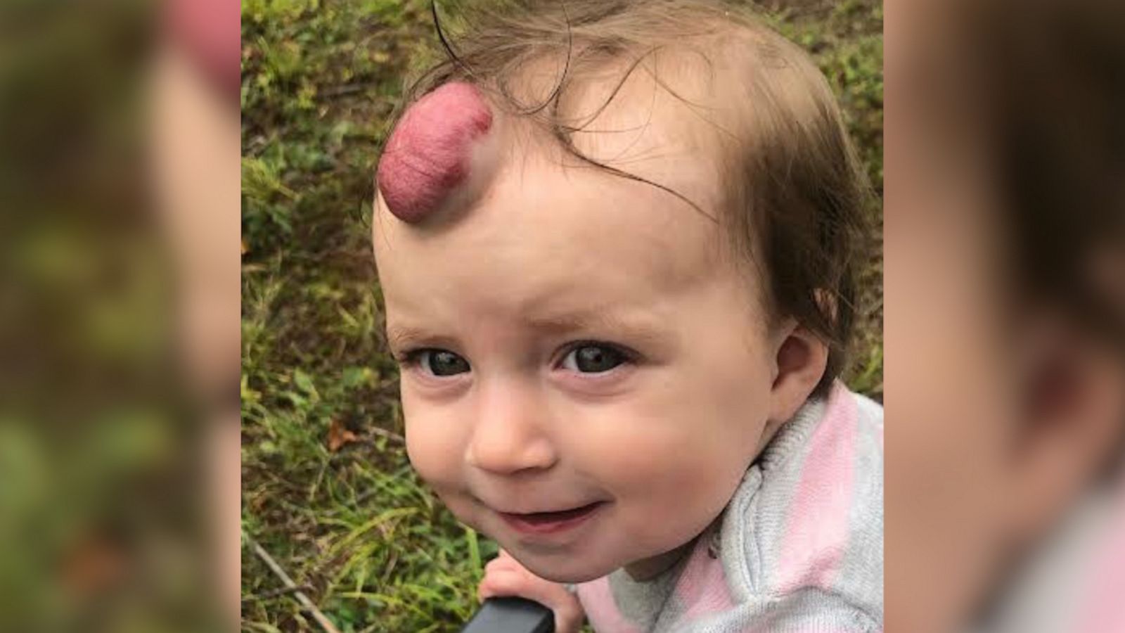 VIDEO: Toddler has giant blood-filled tumor removed and now you can barely tell it was there