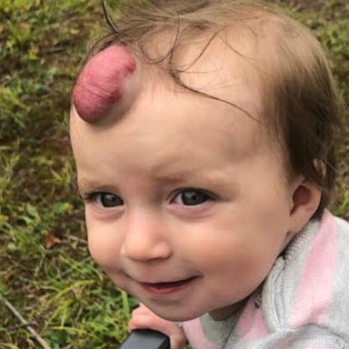 VIDEO: Toddler has giant blood-filled tumor removed and now you can barely tell it was there 