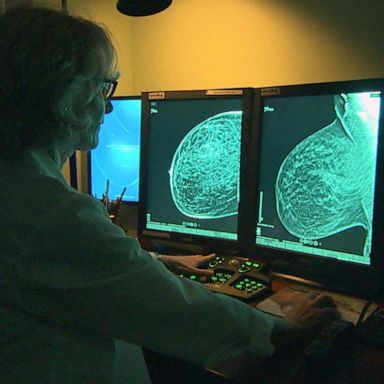 VIDEO: New study on mammogram technology compares likelihood of false positives