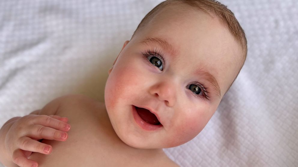 Meet the 2022 Gerber baby who's shining a spotlight on limb differences -  Good Morning America