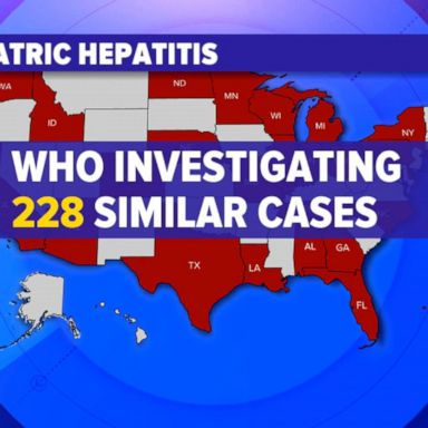 VIDEO: CDC investigating more cases of hepatitis in children