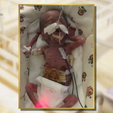 VIDEO: Orlando hospital throws birthday party for ‘micropreemies’ born at 22 weeks 