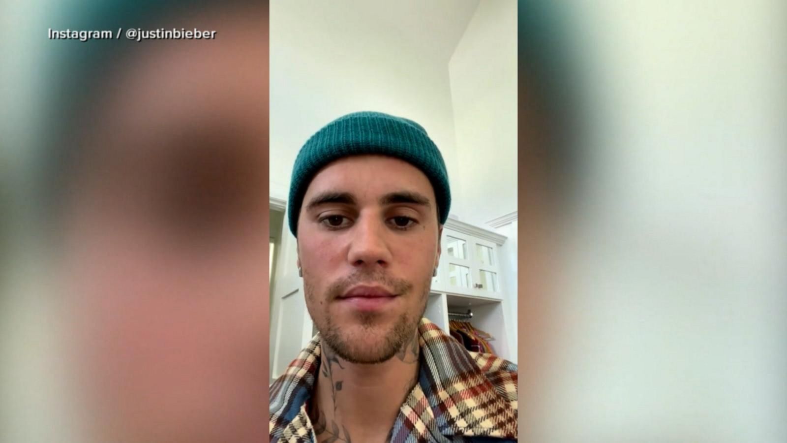 VIDEO: Justin Bieber reveals his face is partially paralyzed