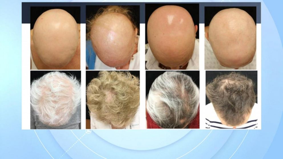 Video FDA approves use of Olumiant to help treat severe alopecia areata -  ABC News