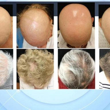 VIDEO: FDA approves use of Olumiant to help treat severe alopecia areata