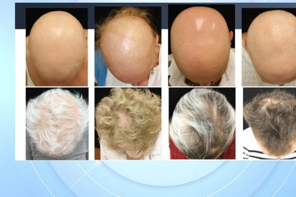 glutathione and alopecia Best Glutathione IV Treatment in Kolkata: Procedure , Types , Price main image 1