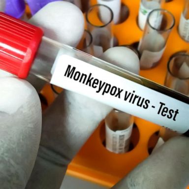 VIDEO: 5th child tests positive for monkeypox in US: What to know