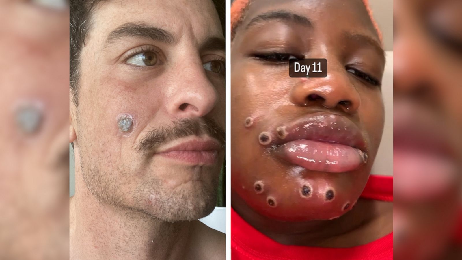 Houston man with monkeypox on face believes a kiss caused it