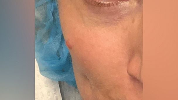 woman-diagnosed-with-cancer-after-finding-bump-on-face-flipboard