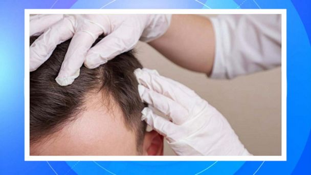 New study finds some natural hair loss remedies may work