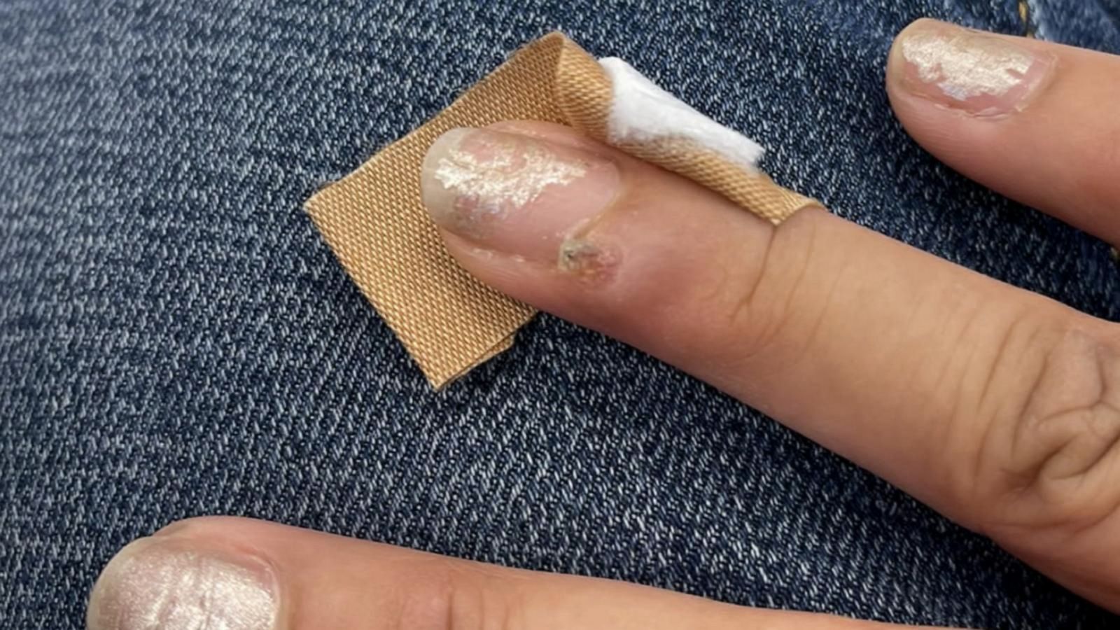 Woman claims she got HPV-related nail cancer after salon visit - Good  Morning America