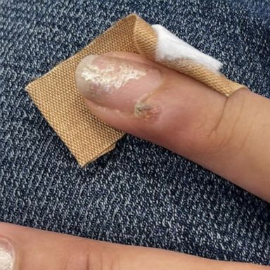 VIDEO: Woman claims she got HPV-related nail cancer after salon visit