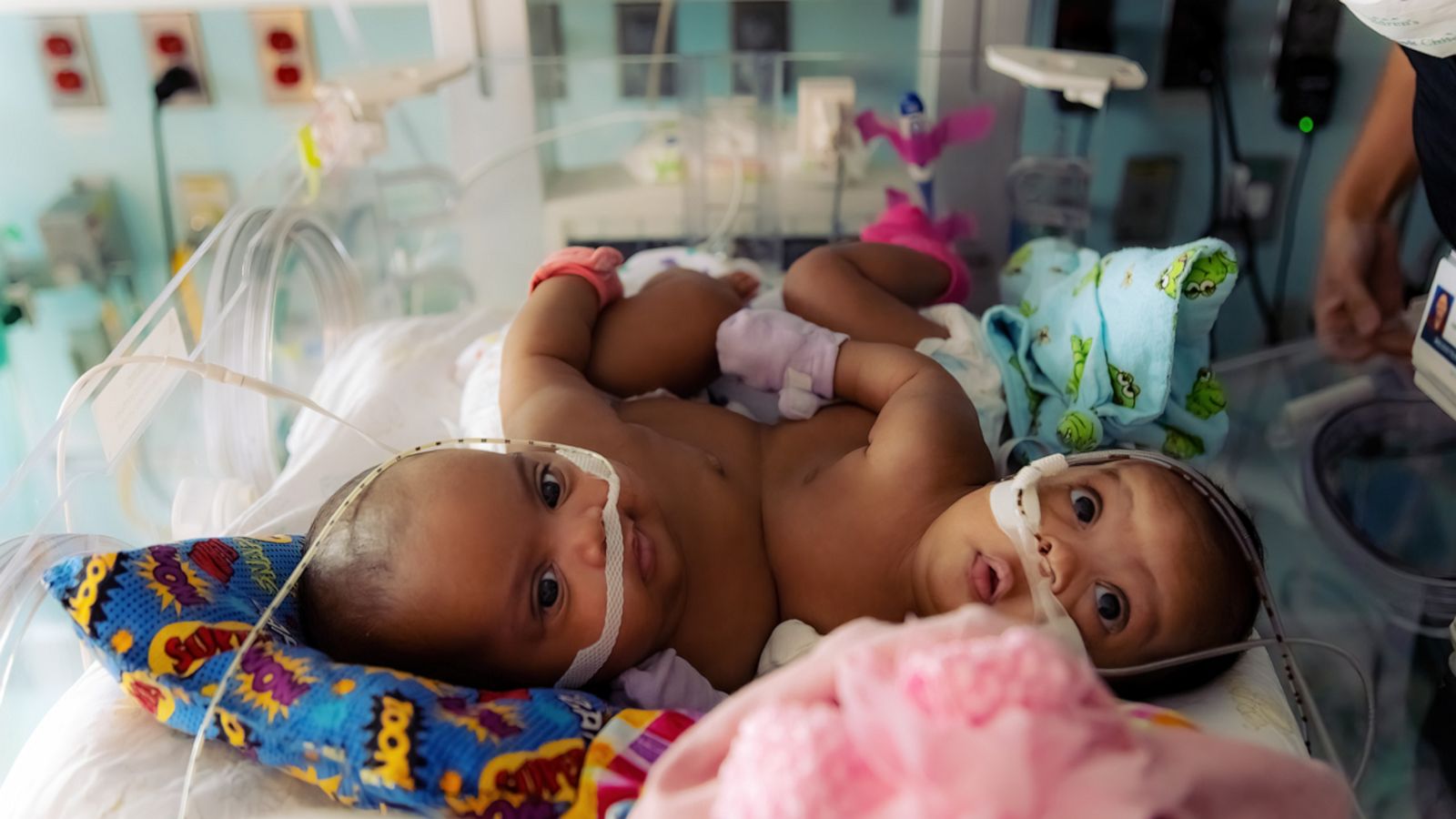 VIDEO: Conjoined twin sisters successfully separated in historic surgery at Texas hospital