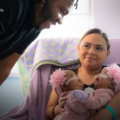 VIDEO: Conjoined 3-month-old twins undergo successful separation surgery