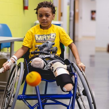 VIDEO: Michigan boy had both of his legs amputated after strep and influenza A infections