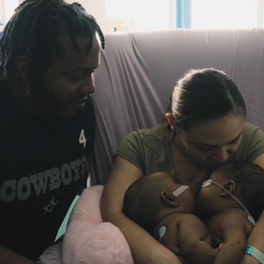 VIDEO: 2nd formerly conjoined twin heads home