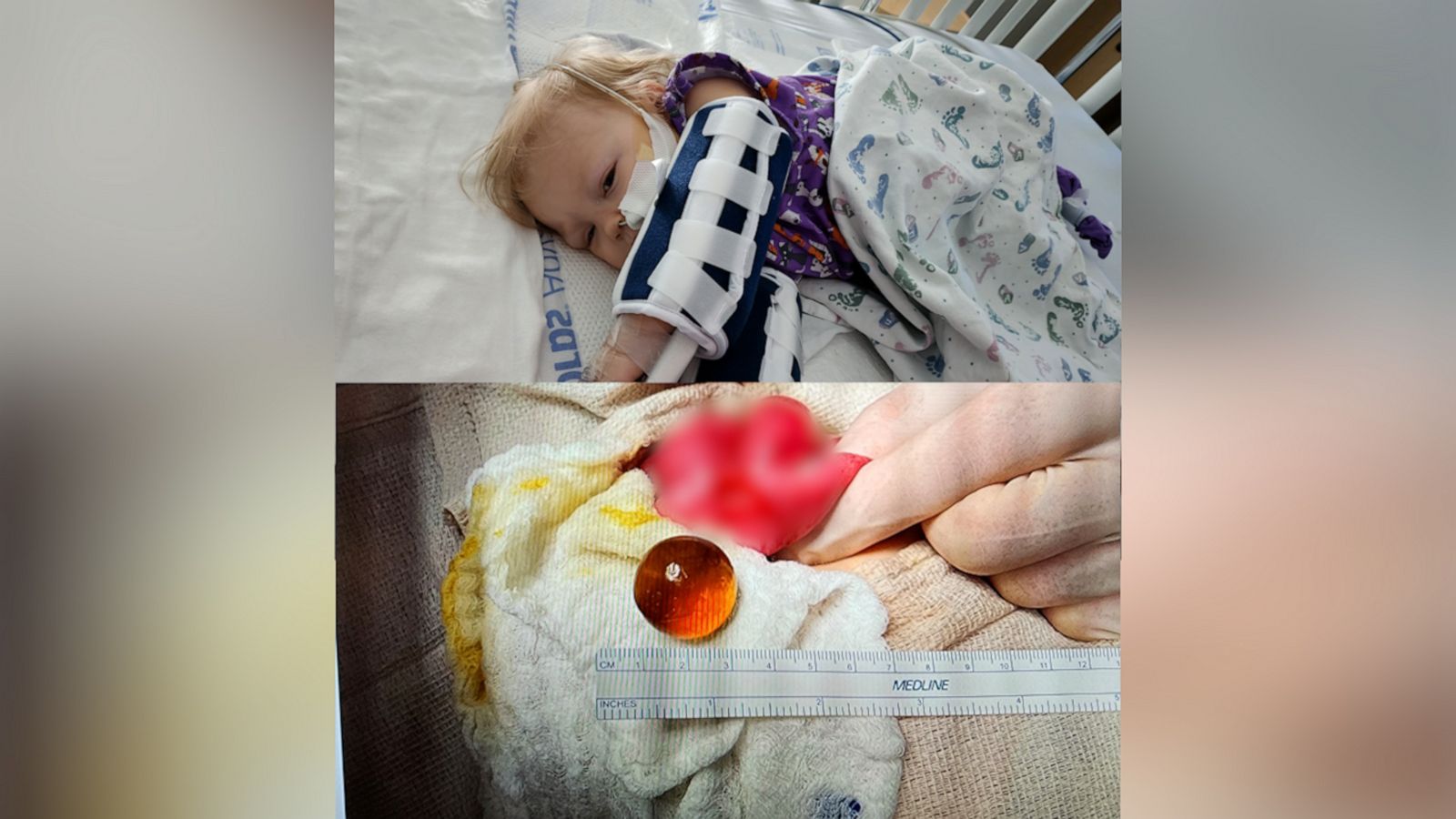 mom-shares-harrowing-story-of-toddler-hospitalized-after-swallowing