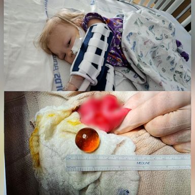 VIDEO: Mom shares harrowing story of toddler hospitalized after swallowing water bead