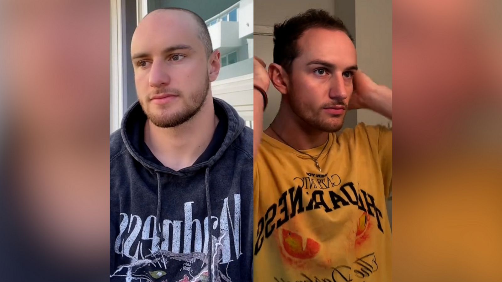 TikTok influencer who started losing hair at 19 breaks stigma around male  hair loss - Good Morning America