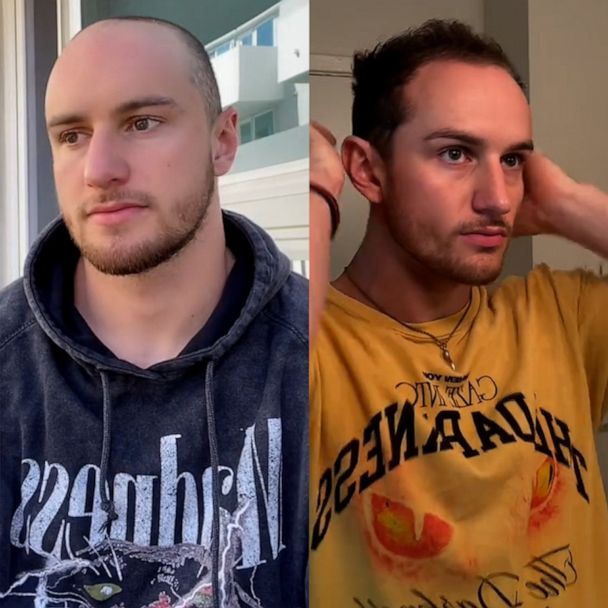 TikTok influencer who started losing hair at 19 breaks stigma around male  hair loss - Good Morning America