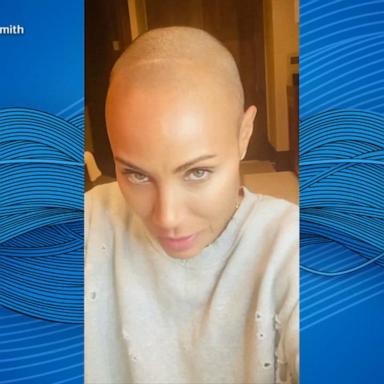 VIDEO: New breakthroughs for those with alopecia