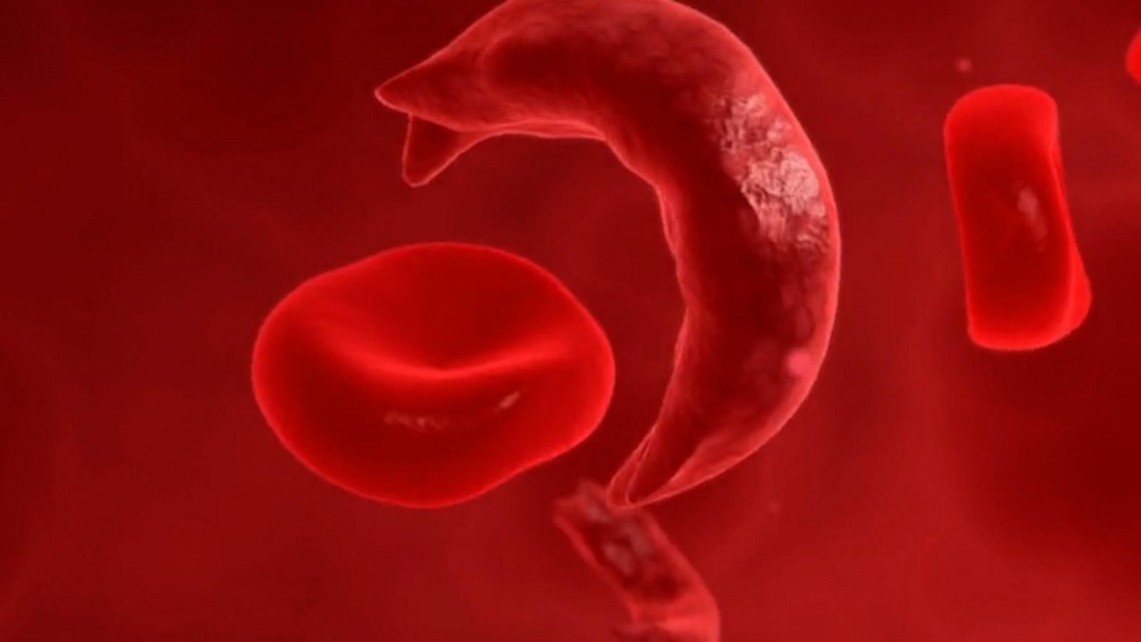 VIDEO: FDA approves 2 breakthrough treatments for those living with sickle cell disease