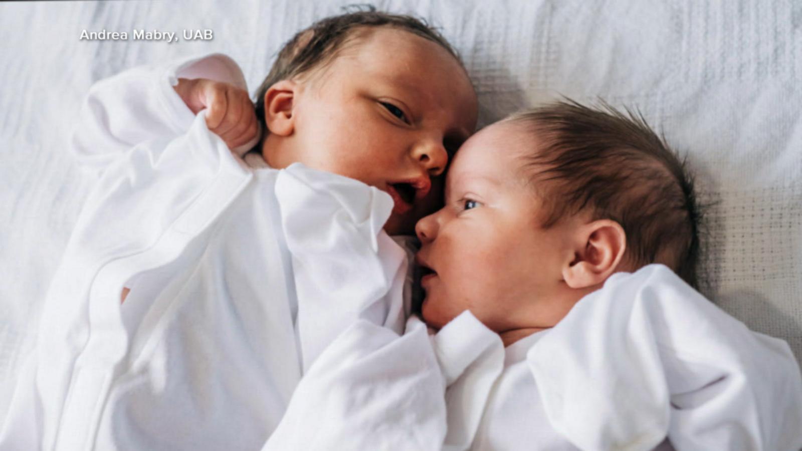 VIDEO: Meet twins born from '1 in a million' pregnancy