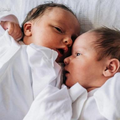 VIDEO: Meet twins born from '1 in a million' pregnancy