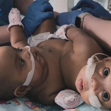 VIDEO: Parents give update on formerly conjoined twins 1 year after surgery