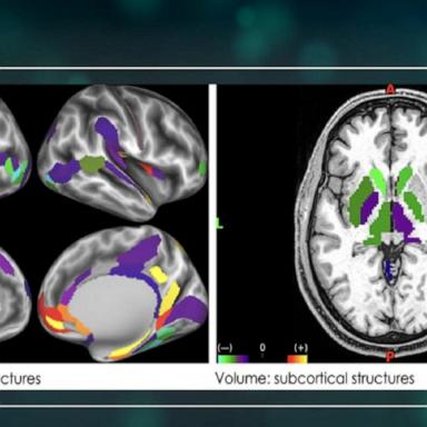 VIDEO: A look at our correspondent’s brain on sugar 