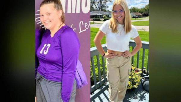gurley semaglutide weight loss With GLP-1s and significant loss, many patients are finally at a weight and size they feel good about., But the skin does not always follow., As plastic surgeons, while we still address areas Semaglutide Weight Loss Injections in