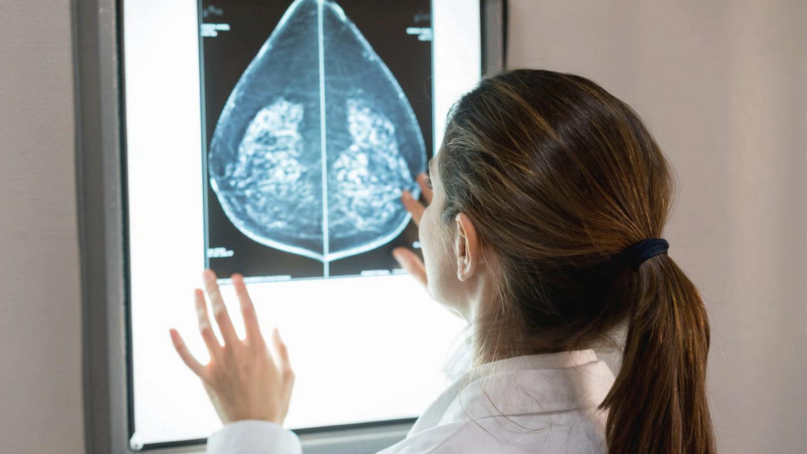 VIDEO: Breast cancer screening guidelines change recommended age to 40