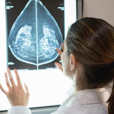 VIDEO: Breast cancer screening guidelines change recommended age to 40