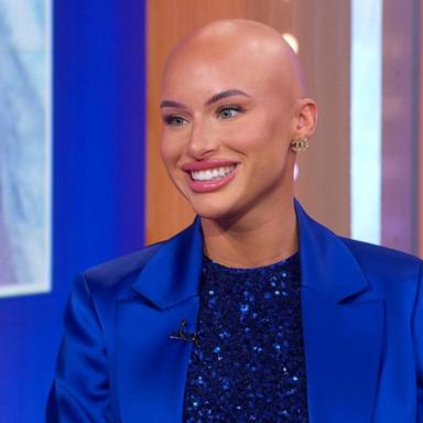 VIDEO: TikTok star Chloe Bean talks alopecia journey