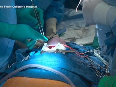 WATCH:  1st successful open heart surgery performed during birth