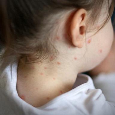 VIDEO: Measles outbreak spreads to more states